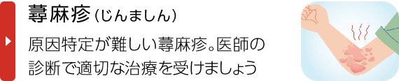 蕁麻疹（じんましん）｜原因特定が難しい蕁麻疹。医師の診断で適切な治療を受けましょう