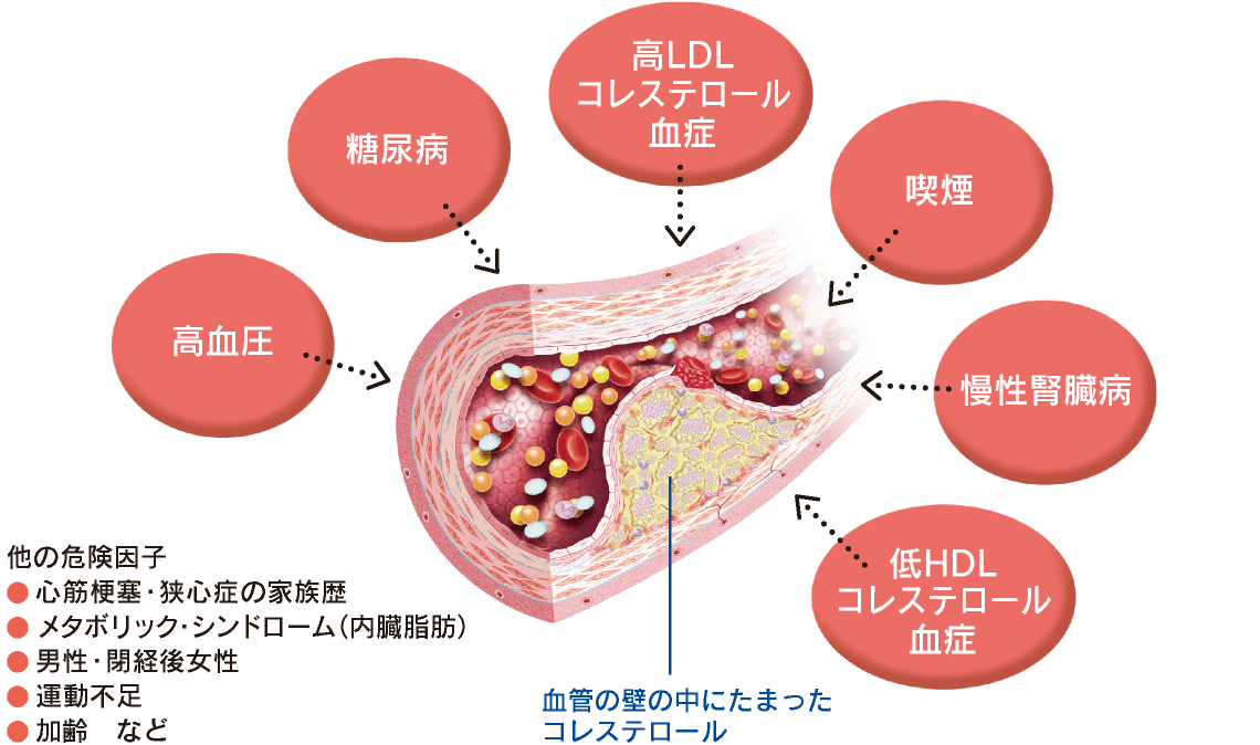 コレステロール値が高いと高血圧になる仕組み